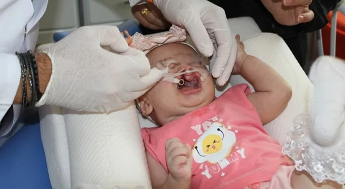 Bursa'da çift taraflı dudak-damak yarığı ile doğan bebeğe başarılı tedavi