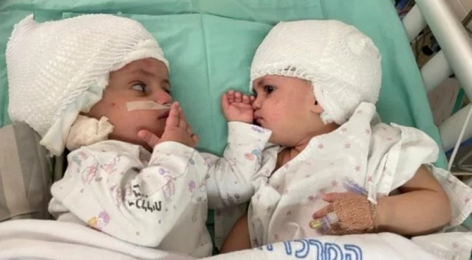 İsrail'de yapışık ikizler 12 saatlik operasyonla ayrıldı