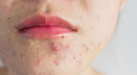 Sivilce tedavisi sürecinde nelere dikkat etmeliyiz?