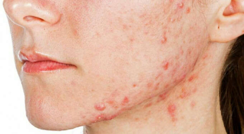 Sivilce tedavisi görüyorsanız bunlardan uzak durun