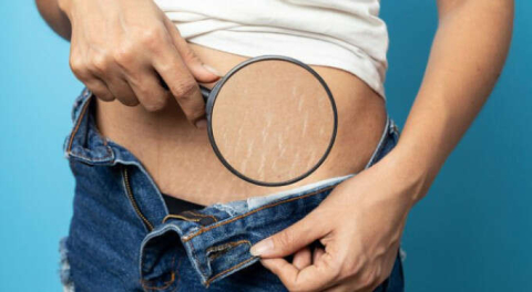 Vücuttaki çatlaklar nasıl geçer?