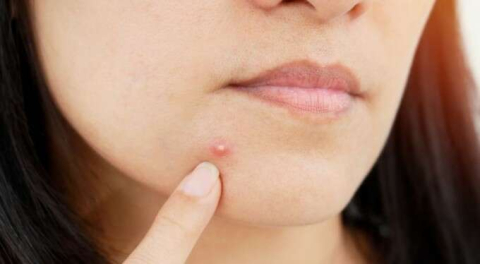 Sivilcelerden kurtulmanın yolu bitkilerde saklı!