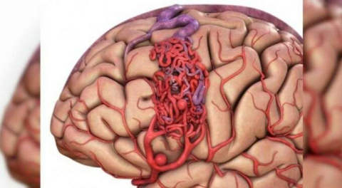 Beyin kanaması nasıl anlaşılır?