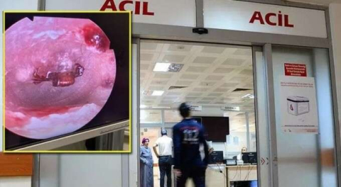 İlk kez rastlandı... Ağrıyla hastaneye gitti, kulağından çıkan şok etti!