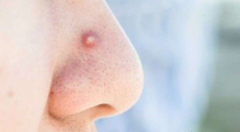 Yüzdeki 'ölüm üçgeni'ne dikkat! Sivilceyi sıktı, beyni iltihapla doldu