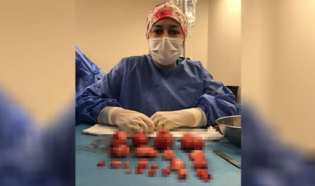 Bursa'da hastanın rahminden 21 miyom çıkarıldı