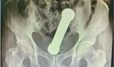 Rektumundan iki kiloluk dambıl çıktı