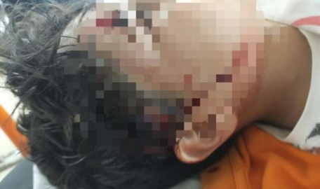 Bursa'da köpek dehşeti! 10 yaşındaki çocuğa 80 dikiş atıldı