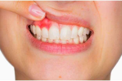 Diş Etinde Şişkinlik ve Kırmızılığa Dikkat !