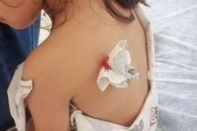 Böcek ısırığı sandılar, yorgun mermi çıktı