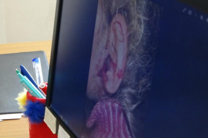 Küçük kızın kulağından çıkanlar şoke etti: Tam 23 tane