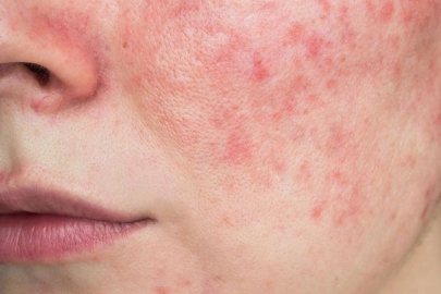 Cilt sorunlarına karşı nelere dikkat edilmeli?