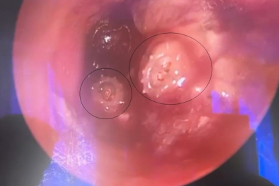 Bursa'da çocuğun kulağından 2 kurtçuk çıkarıldı