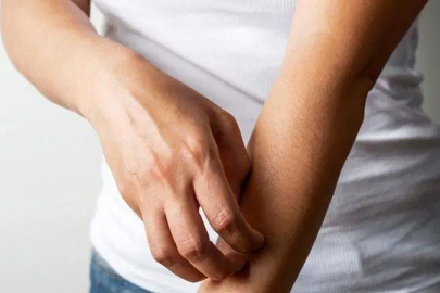 Yazın artan mantar riskine dikkat: Her kaşıntı mantar değildir