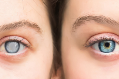 Göz doktorundan uyarı: Kataraktı önlemede beslenme etkili