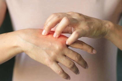 Soğuk havalarda en çok görülen cilt hastalıkları