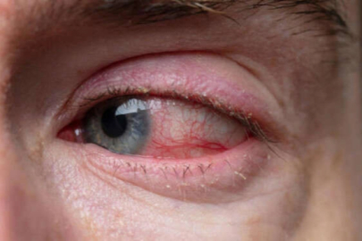 Bahar aylarındaki göz alerjisi görme kaybına yol açabilir