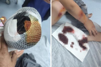 Köpek saldırısına uğrayan çocuğun başına 15 dikiş atıldı