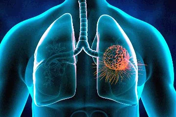 Akciğer kanseri görülme yaşı gittikçe düşüyor
